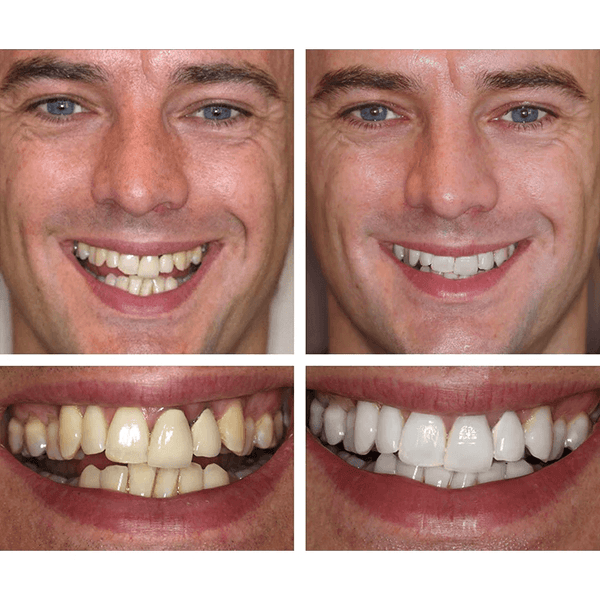 MyDentin Teeth Whitening Essence
